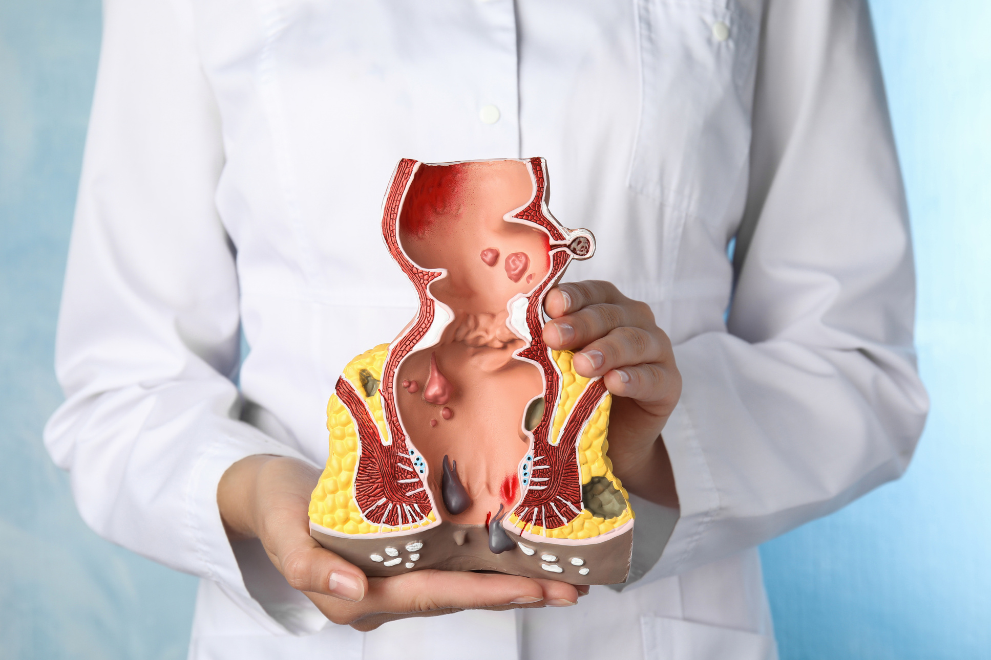 Doctor Holding Model of Unhealthy Lower  on Light Blue Background, Closeup. Hemorrhoid Problem