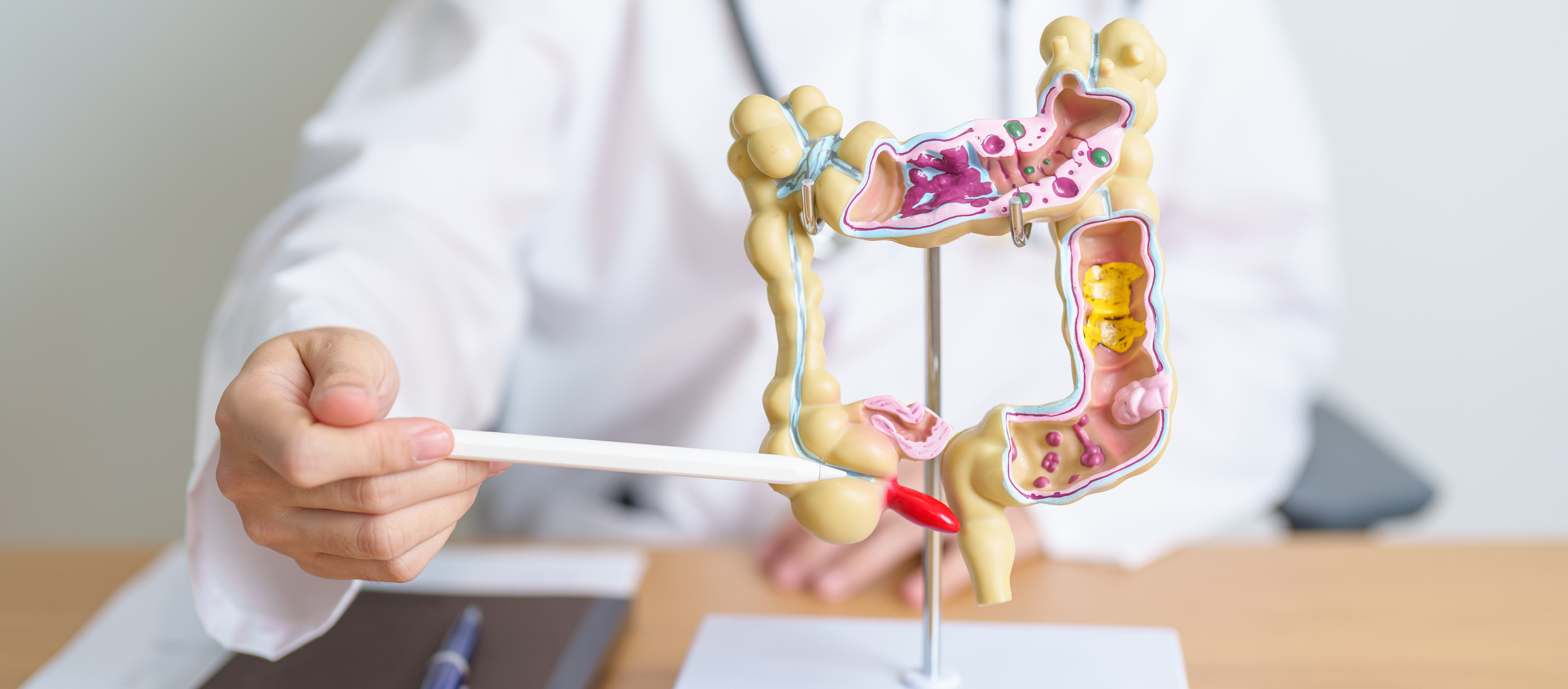 Doctor with human Colon anatomy model. Colonic disease, Large Intestine, Colorectal cancer, Ulcerative colitis, Diverticulitis, Irritable bowel syndrome, Digestive system and Health concept