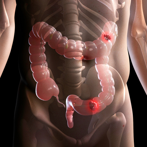 "Bowel cancer