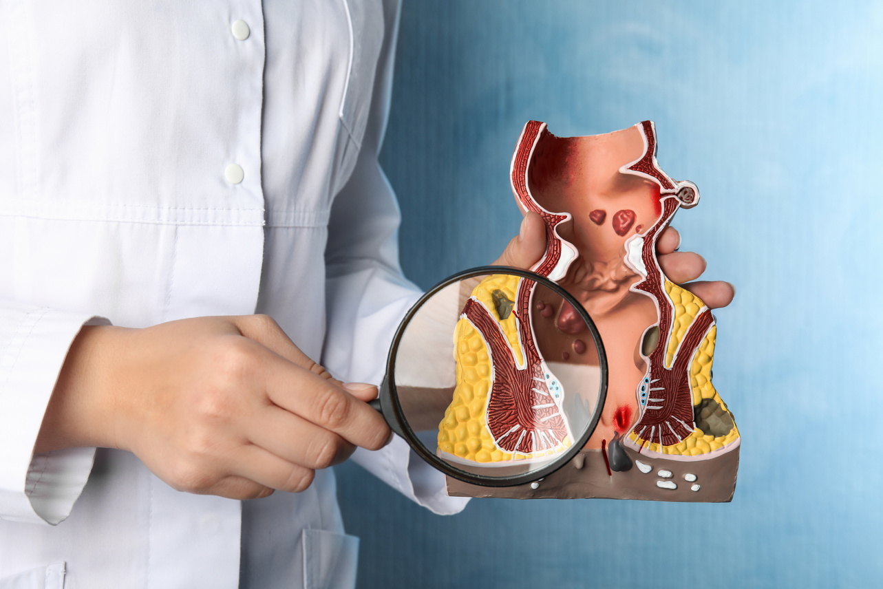 Doctor with Magnifying Glass Showing Model of Unhealthy Lower  on Light Blue Background, Closeup. Hemorrhoid Problem